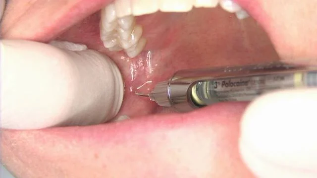 Modified Inferior Alveolar Nerve Block Injection Technique on Vimeo