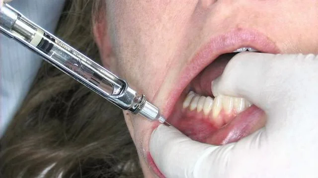 Mental and Incisive Nerve Block Injection Technique | Videos & Movies ...