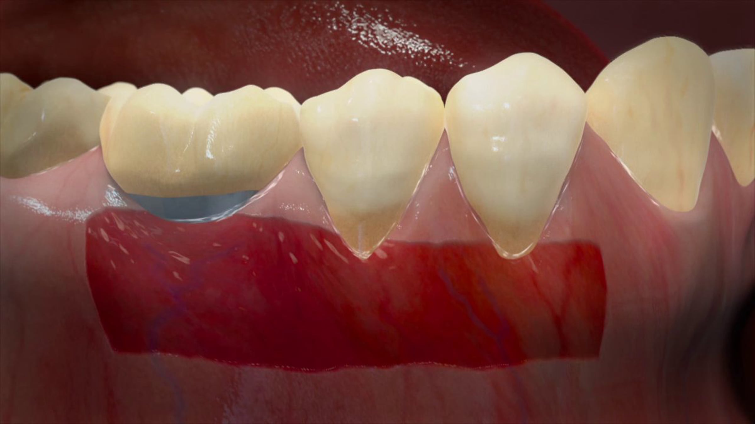 GINTUIT™ for Oral Soft Tissue Regeneration | Videos & Movies on Vimeo