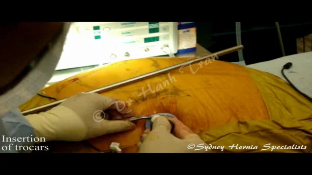 Inguinal Hernia Surgery Sydney