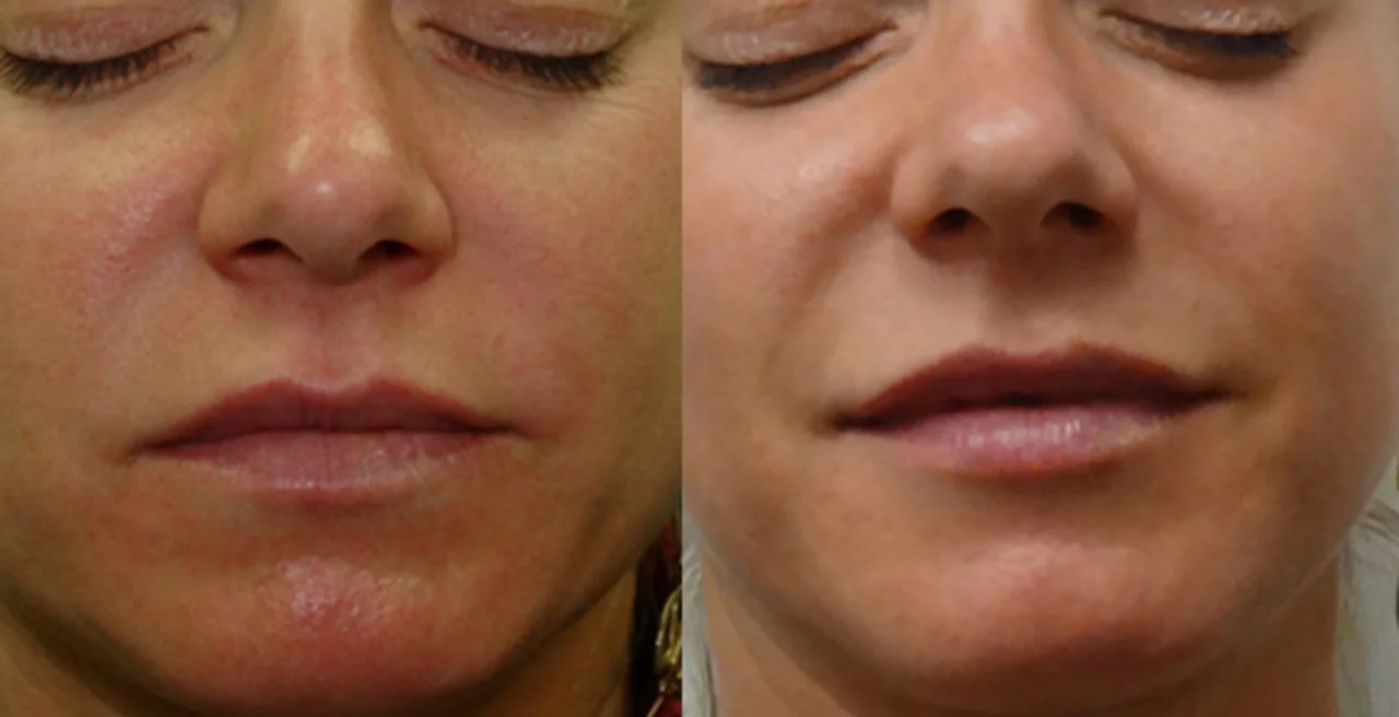 Губы белотеро 0.6 до и после Lip injection with Belotero, Dr Javier Zelaya NYC Dermatologist
