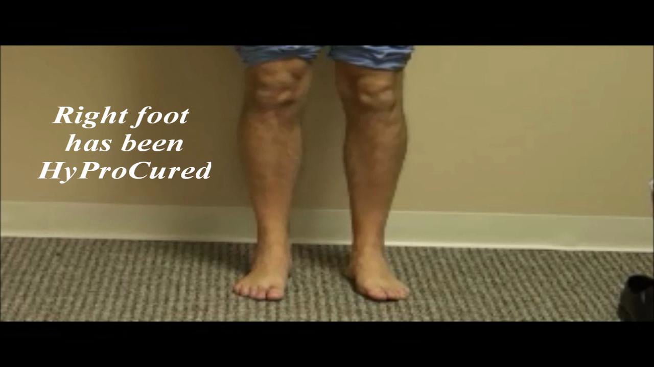 Before after video