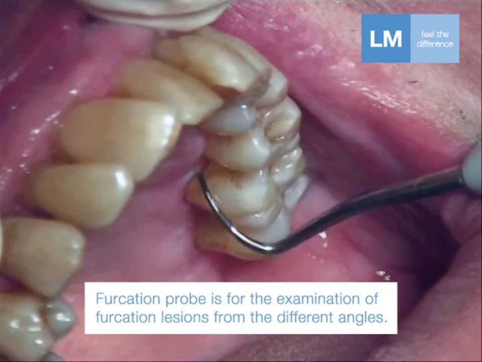 Clinical use of: Furcator and furcation Probe on Vimeo