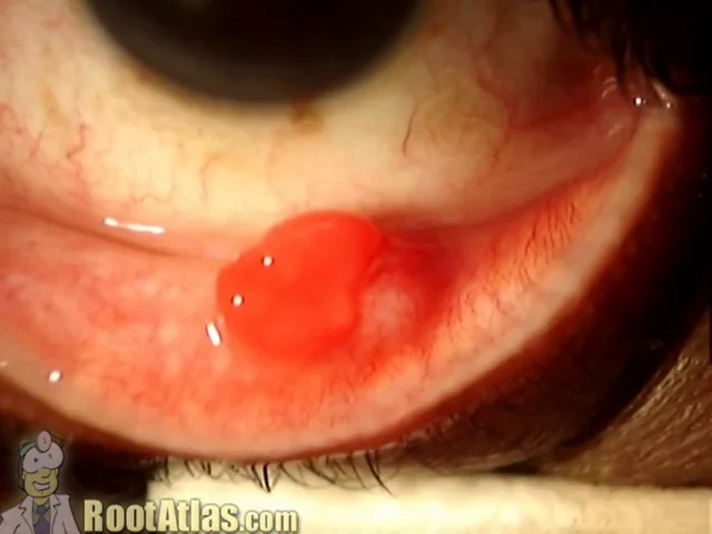 pyogenic granuloma eye treatment