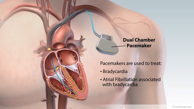 Piedmont Healthcare LV Myocardial Strain Workflow on Siemens SC200 on Vimeo