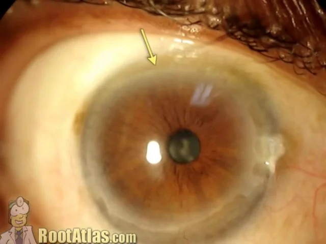 corneal degeneration treatment