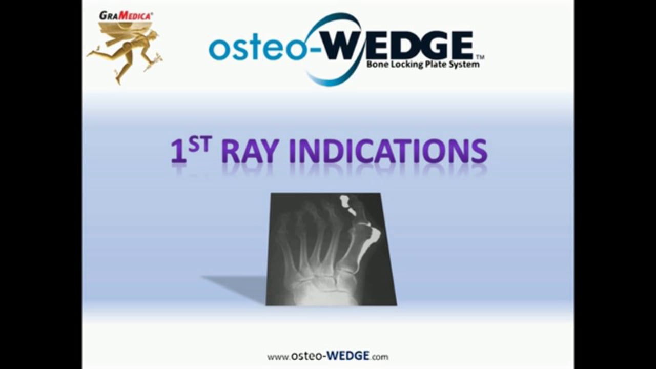 osteo-WEDGE Benefits
