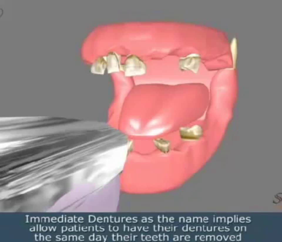 Dental Implants On Vimeo