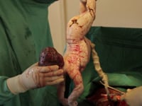 African Caesarean section and child delivery at Mukono Health Centre Uganda