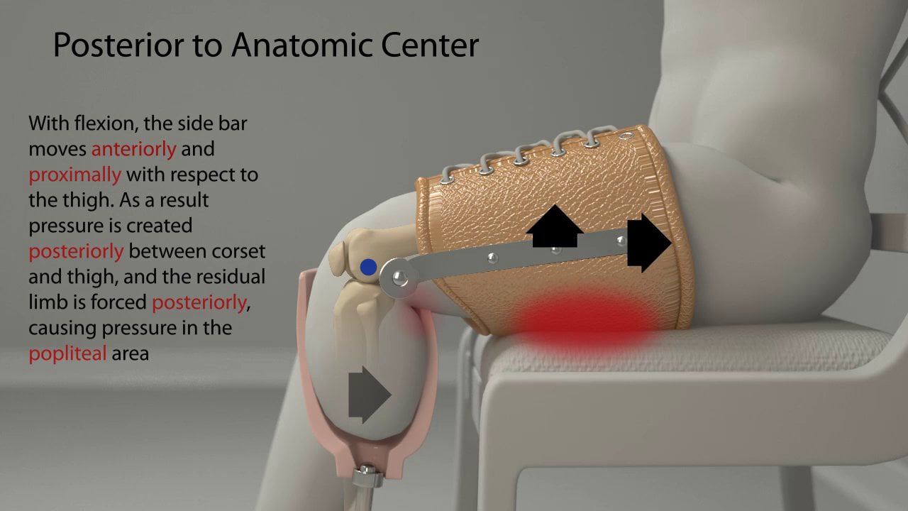Proper Joint Alignment for a Transtibial Joint and Corset Prosthesis on ...