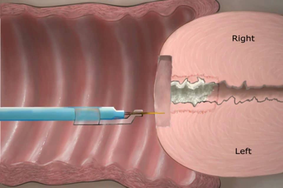 LEEP Conization Procedure on Vimeo