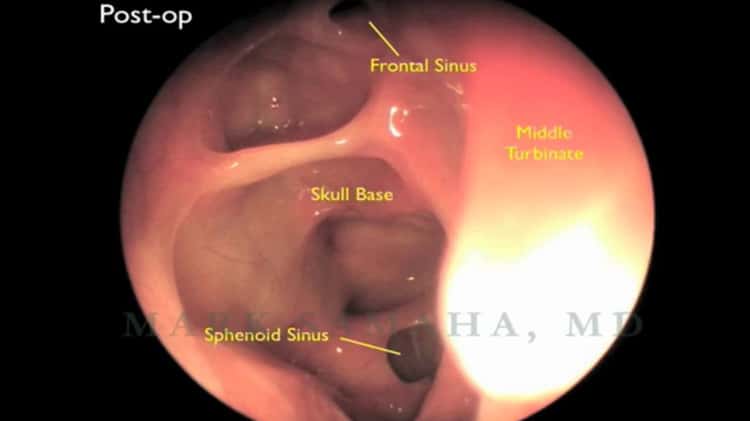 Endoscopic sinus surgery