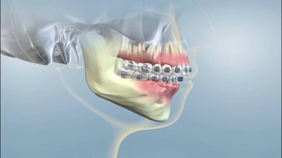 Having Orthognathic Surgery Class 2 on Vimeo