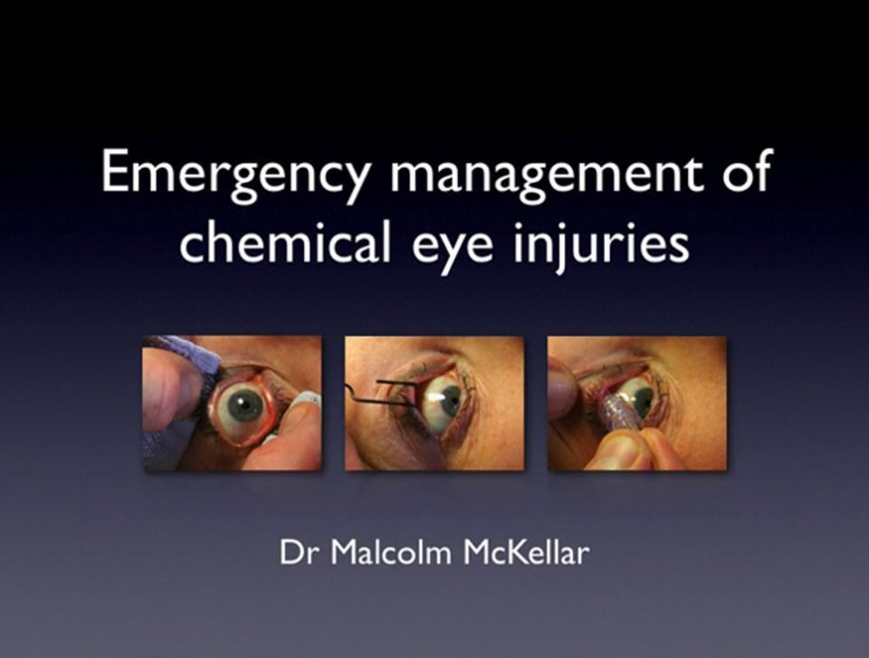 Chemical Eye Injury Management on Vimeo