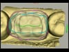Dental Education Video - CEREC