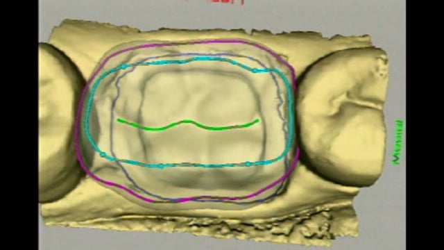 CEREC same-day crown technology