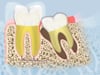 Dental Education Video - Wisdom Tooth Development