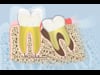 Dental Education Video - Wisdom Tooth Problems