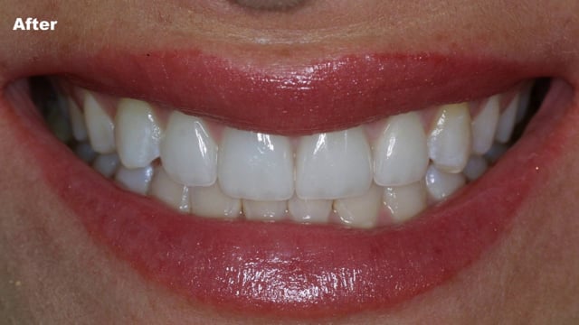 Powerprox 6-Month Braces