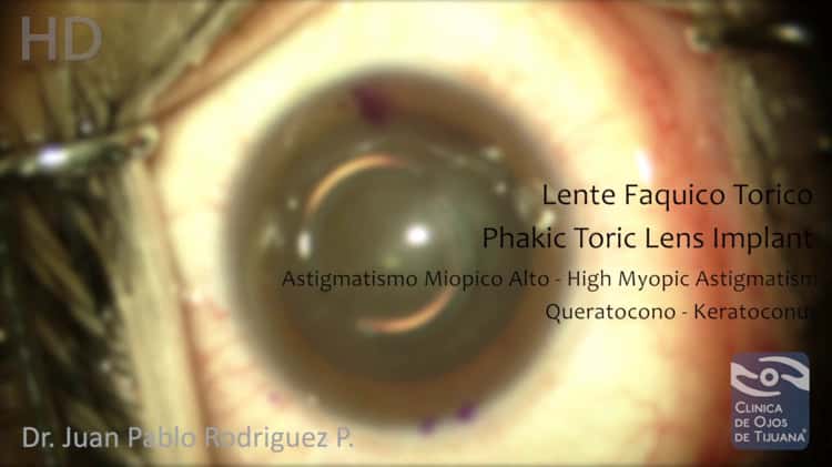 Lente intraocular online faquica