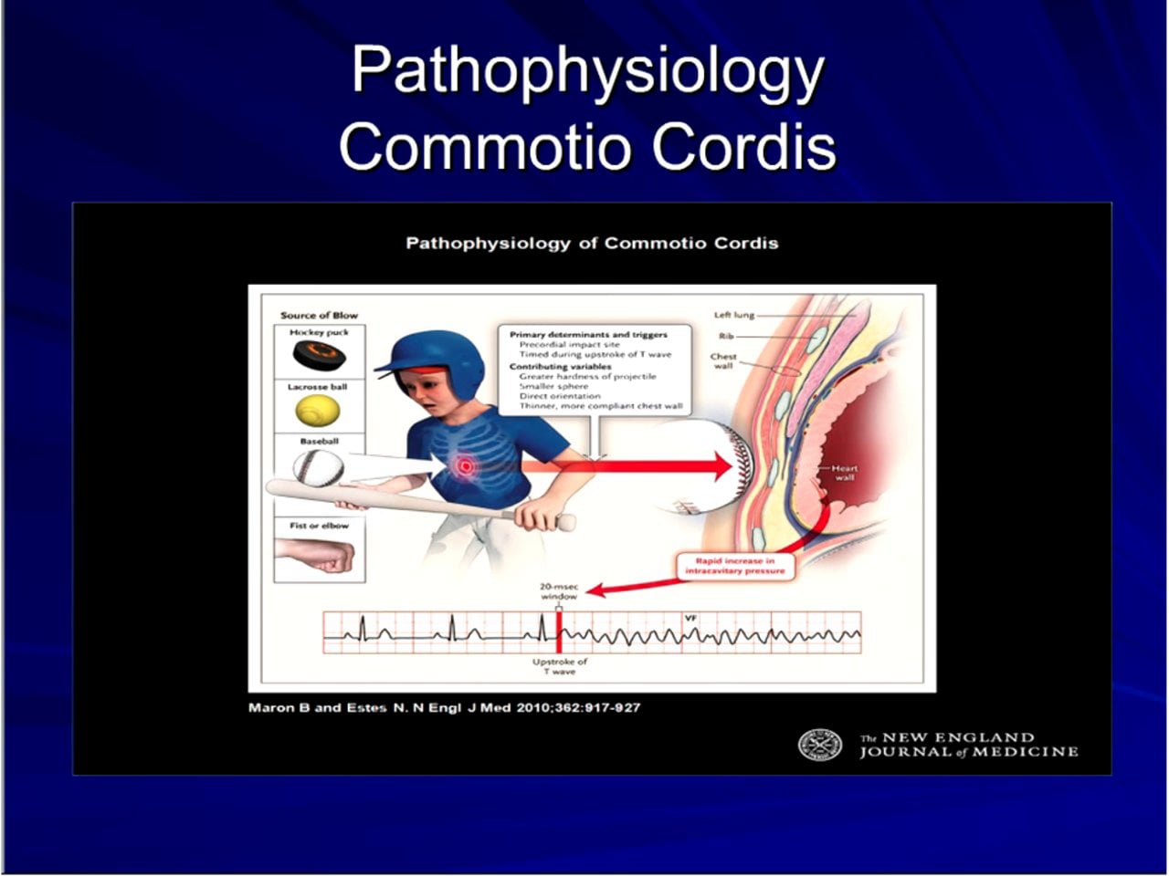 Commotio Cordis Sudden Cardiac Death in Athletics on Vimeo