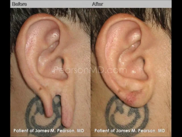 Earlobe Repair - The Complete Awesome Guide with Tips and