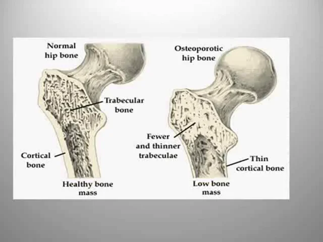 trabecular bone osteoporosis