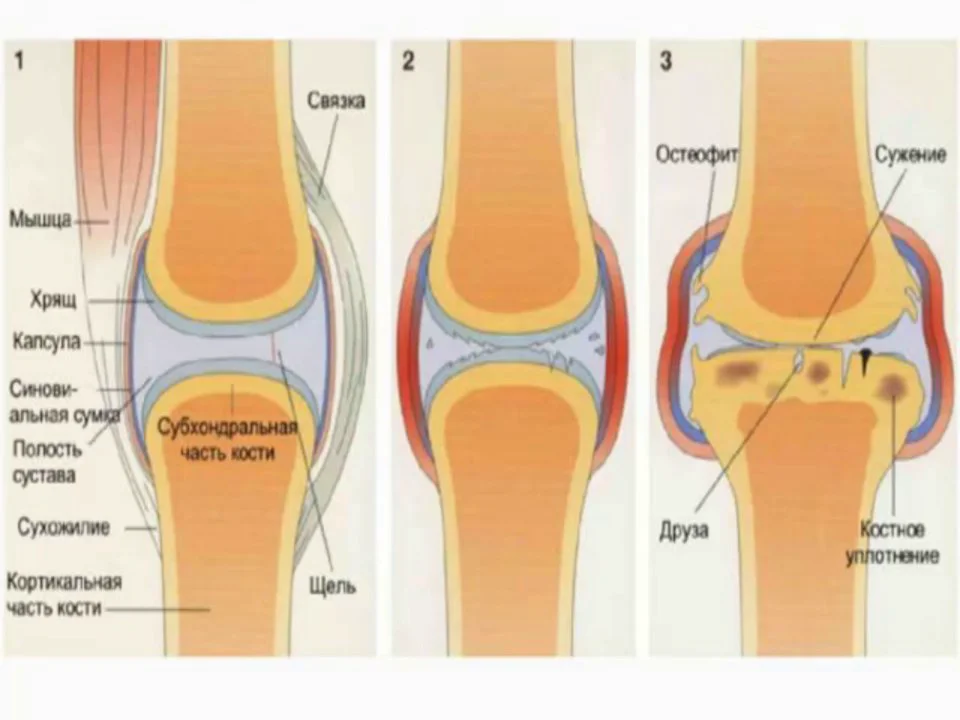 Субхондральный склероз смежных суставных поверхностей. Остеосклероз тазобедренного сустава. Остеосклероз тазобедренного сустава рентген. Узурация суставных поверхностей что это такое. Склероз суставных поверхностей коленного сустава что это.