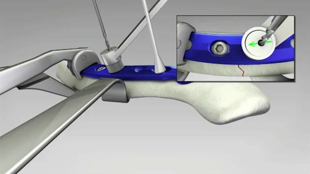 Locking Superior Midshaft and Anterior Clavicle Plates Surgical Technique  Animation