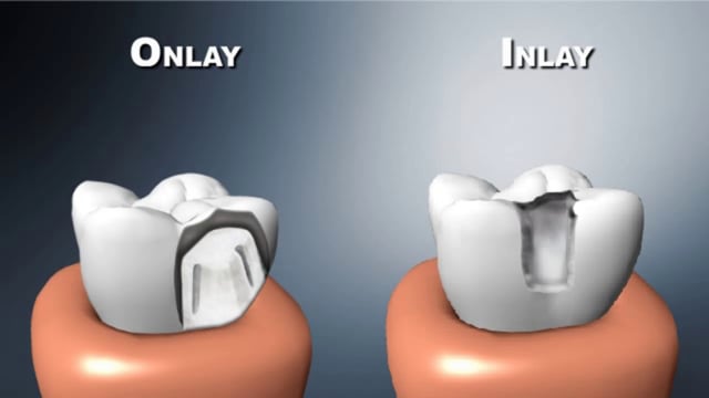 Inlays and Onlays