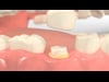 Functional Crown Lengthening