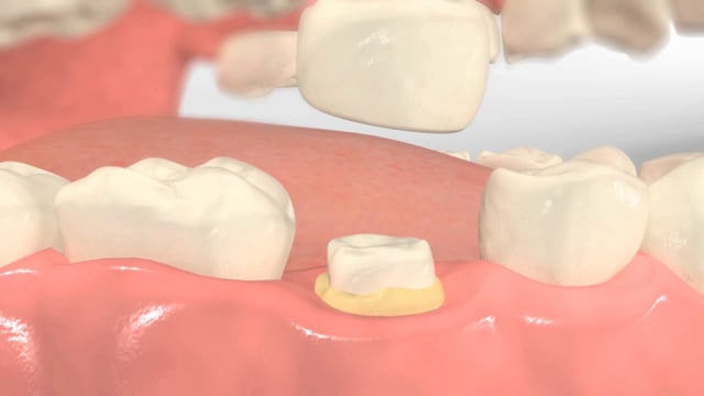 Functional Crown Lengthening