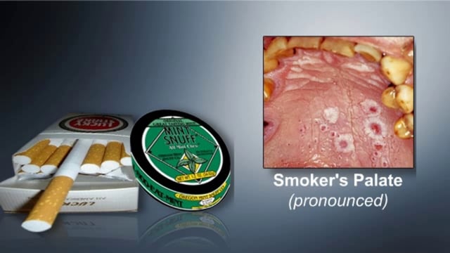 tobacco for gums It may be smokeless, but it's still Using dip takes a toll