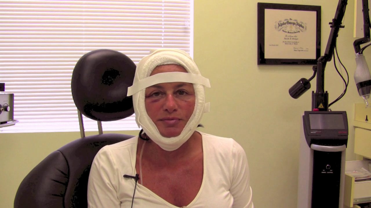 Facelift Bandages One Day After Surgery on Vimeo