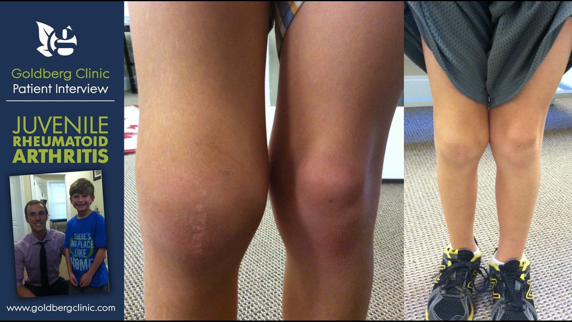 Juvenile Rheumatoid Arthritis Patient Interview