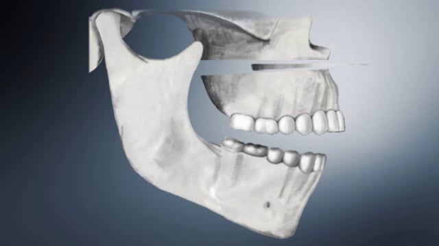 Jaw Surgery