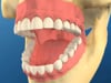 Snap In Dentures