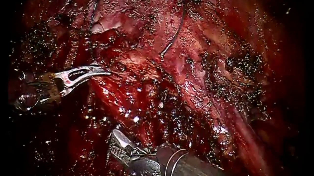 Robotic Excision of Full Thickness Bladder Endo Small