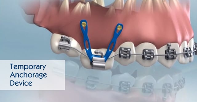 Temporary Anchorage Devices