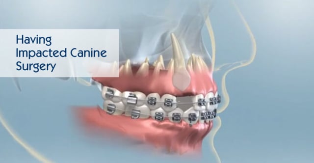 Having Impacted Canine Surgery