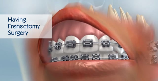 Having Frenectomy Surgery