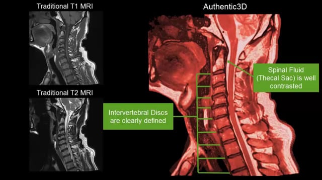 Thecal Sac Mri