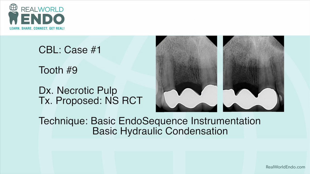 CBL 1 Anterior Tooth Endodontics using the EndoSequence Technique