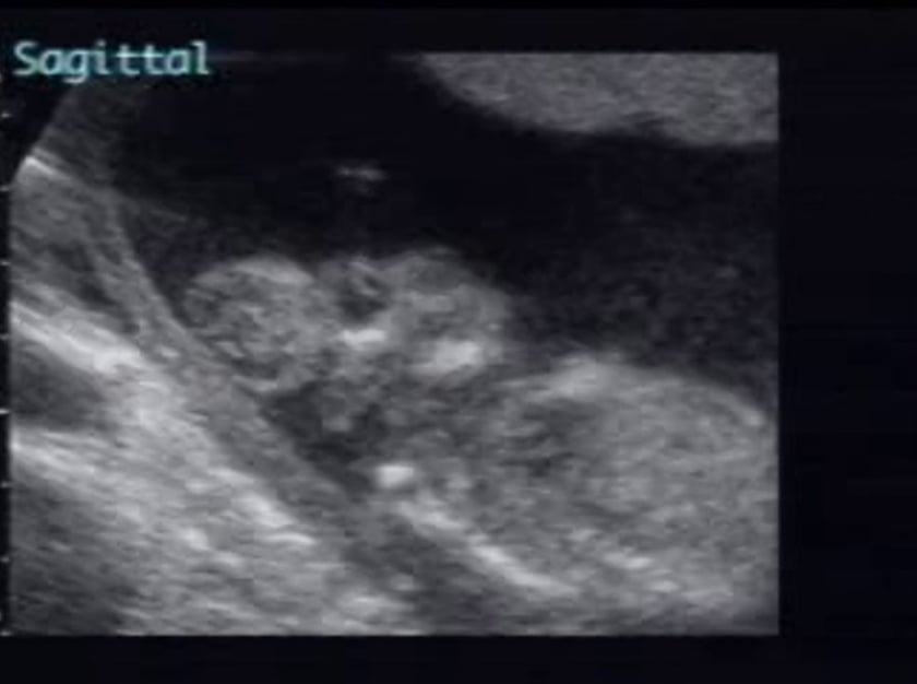 anencephaly ultrasound findings