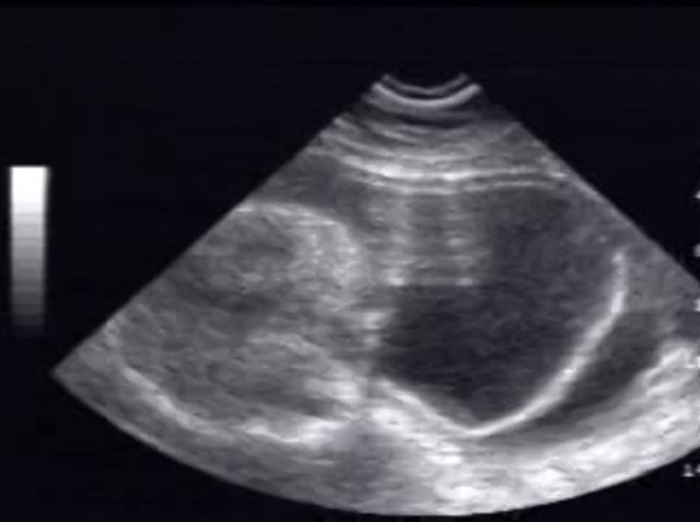 Meningocele cranial -occipital – ULTRASOUNDPAEDIA