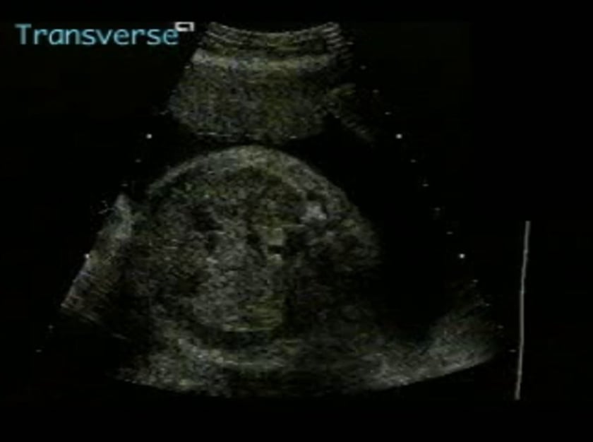 Meningomyelocele – ULTRASOUNDPAEDIA