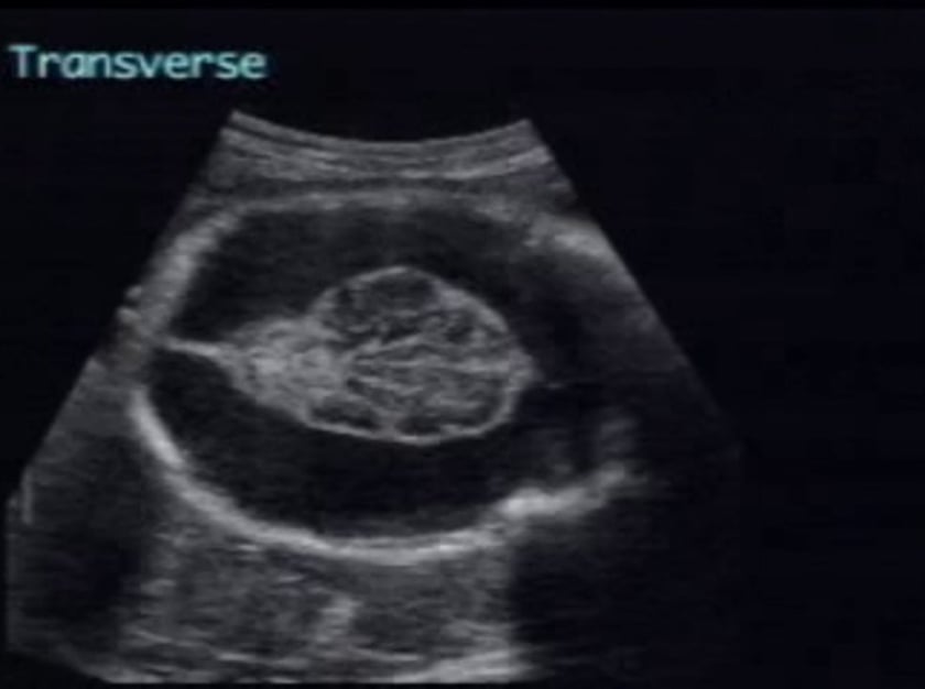 fetal porencephaly