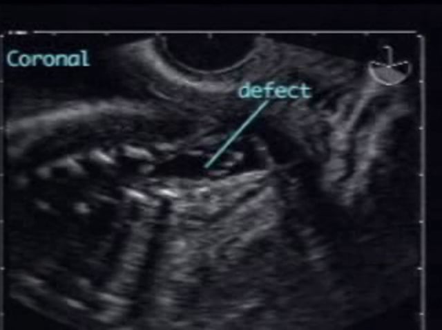Meningomyelocele – ULTRASOUNDPAEDIA