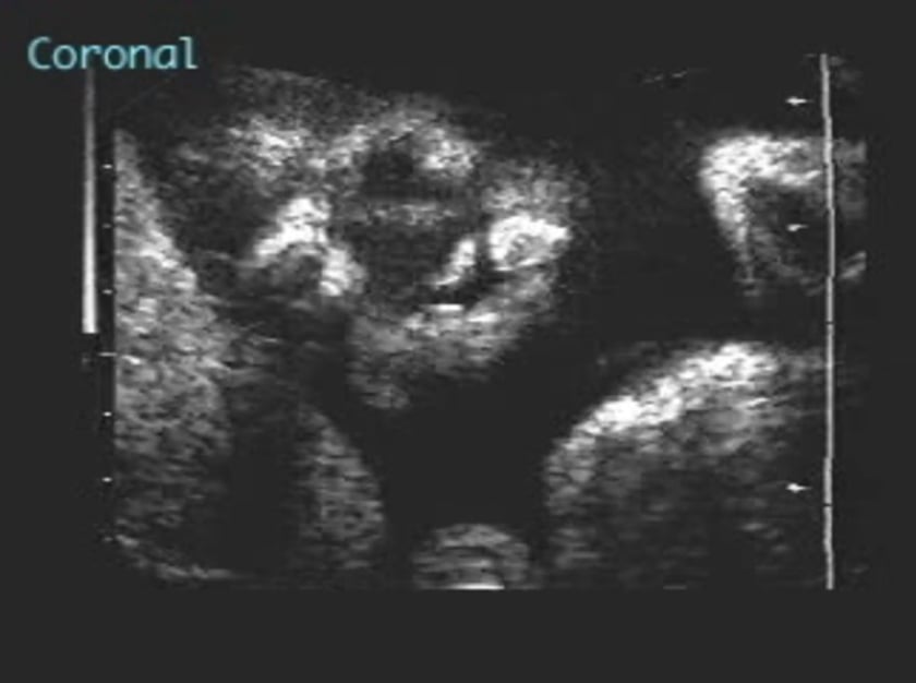 cleft palate ultrasound profile