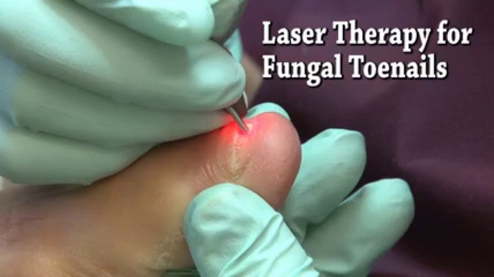 Laser Treatment For Toenail Fungus - Podiatrist In Baltimore And ...